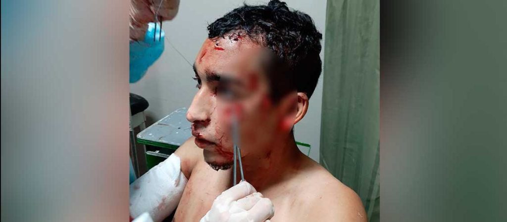 Venezolano es atacado en Perú con picos de botella para robarlo